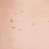 Red Moles On Skin: All That You Need To Know