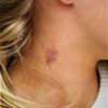 How To Get Rid Of A Hickey?