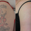 Laser & Non-Laser Tattoo Removal at TattooRemoval Clinic