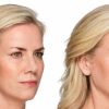 Lifting and Contouring with Juvéderm Voluma - Rejuvenate Your Cheeks and Midface